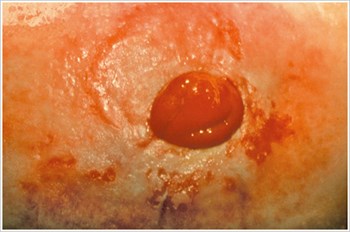 Irritant Dermatitis