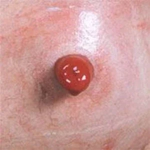 Gezonde peristomale huid
