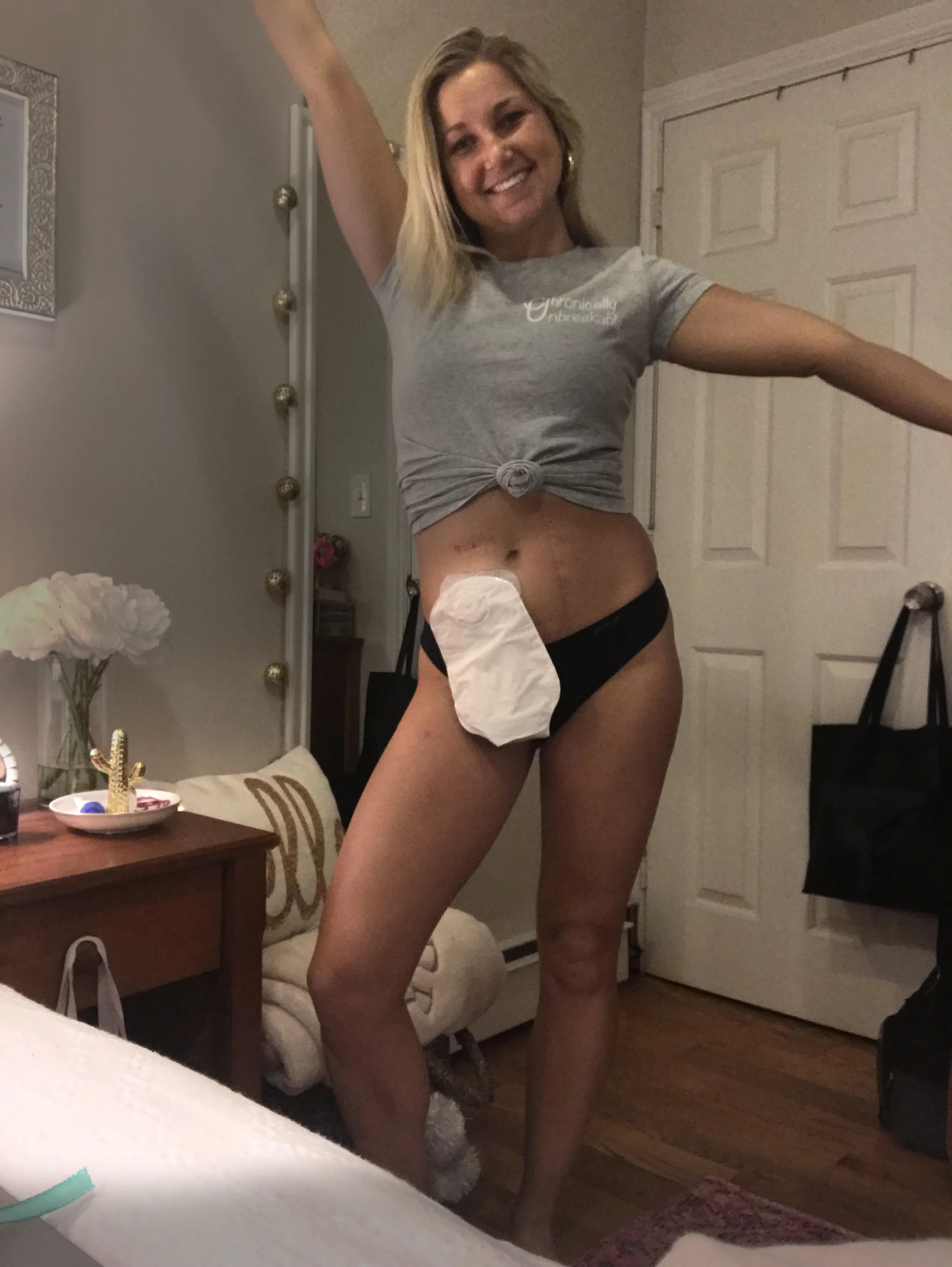 有造口的女士